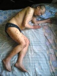 Red marks Mr. Pan Benyus body resulted from a combination of scabies and cigarette burns from policemen. He also suffered from sever edema as a result of compromised cardiac and liver function.